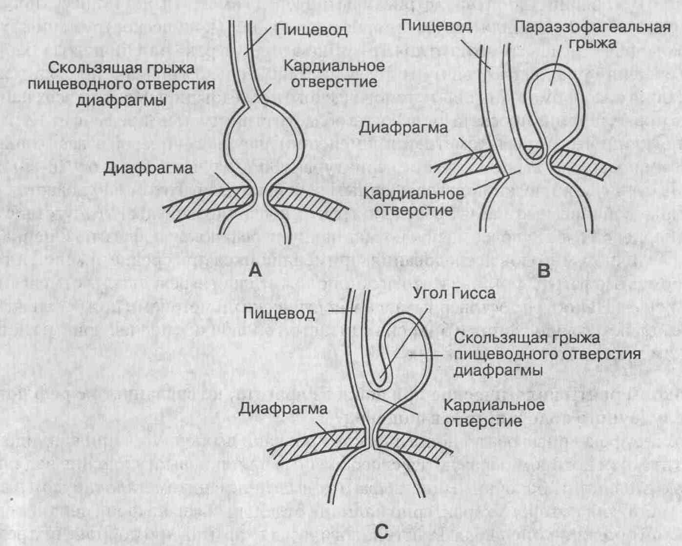 Диета При Аксиальной Грыже