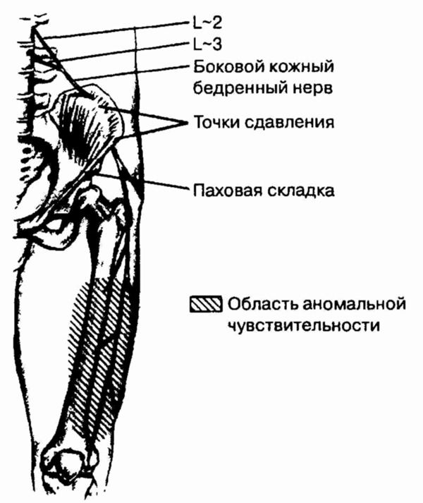 Невропатия наружного кожного нерва