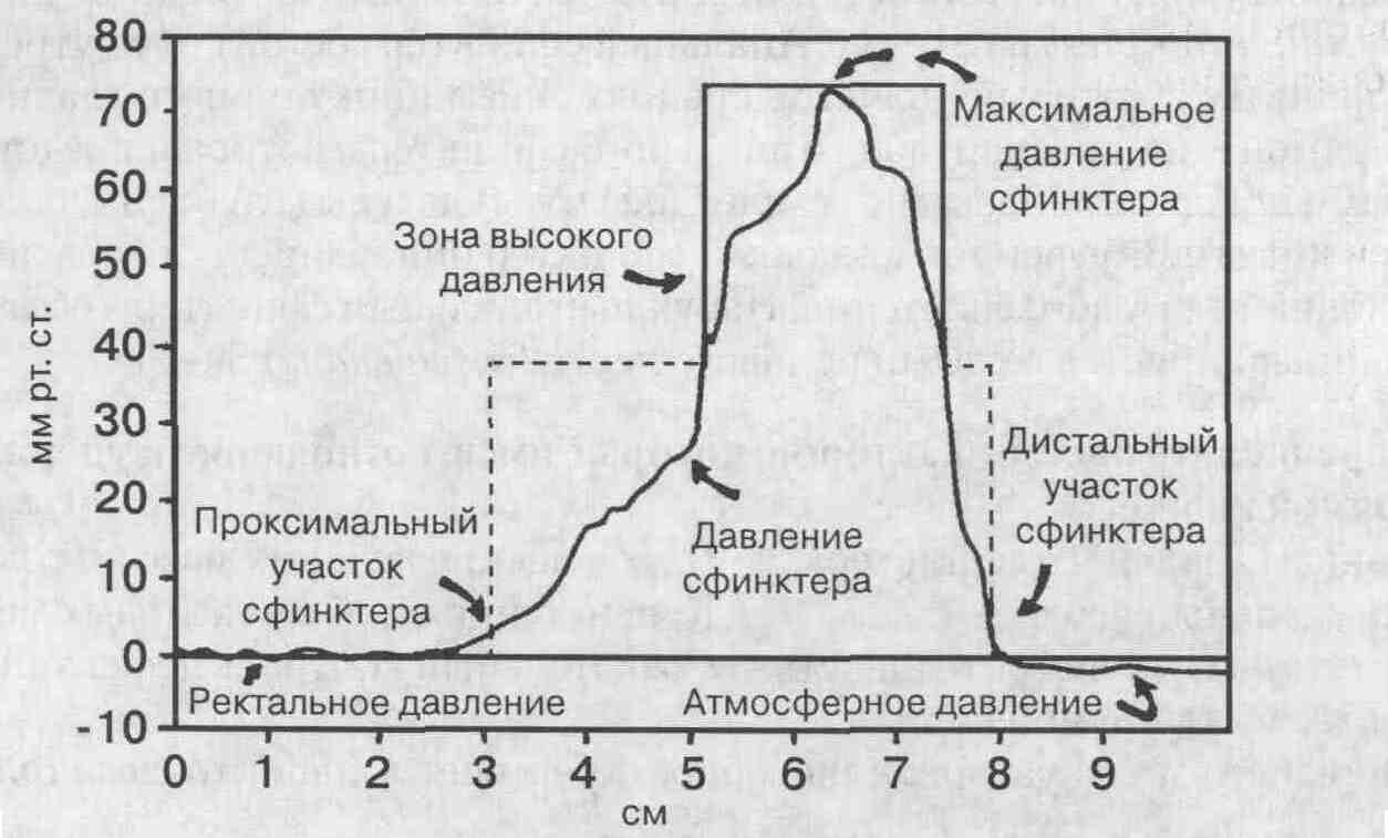 Снять спазм сфинктера при трещине. Сфинктерометрия норма. Нормотонус сфинктера это.