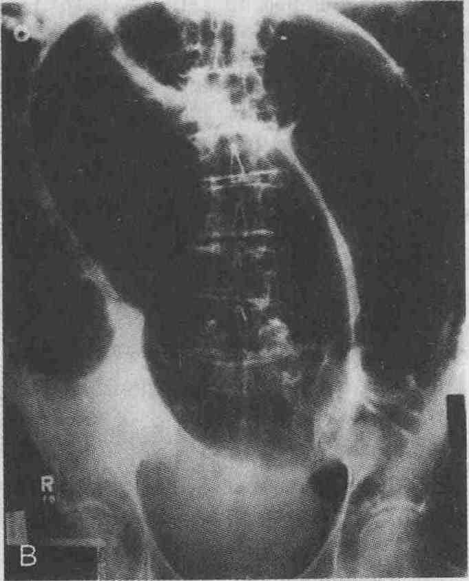 Расширение петель кишечника. Заворот слепой кишки рентген. Заворот толстой кишки рентген. Заворот сигмовидной кишки рентген.