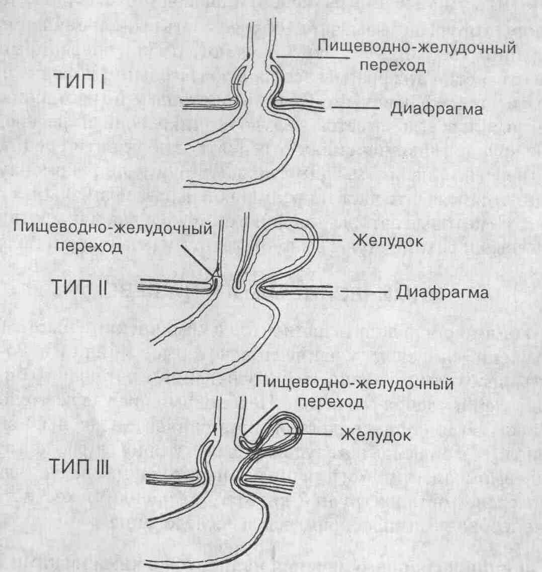 Z линия пищевода. Грыжа пищеводного диафрагмы. Грыжа пищеводного отверстия диафрагмы 1 типа. Диафрагмальная эзофагеальная грыжа. Эндоскопическая анатомия пищеводно - желудочного перехода.