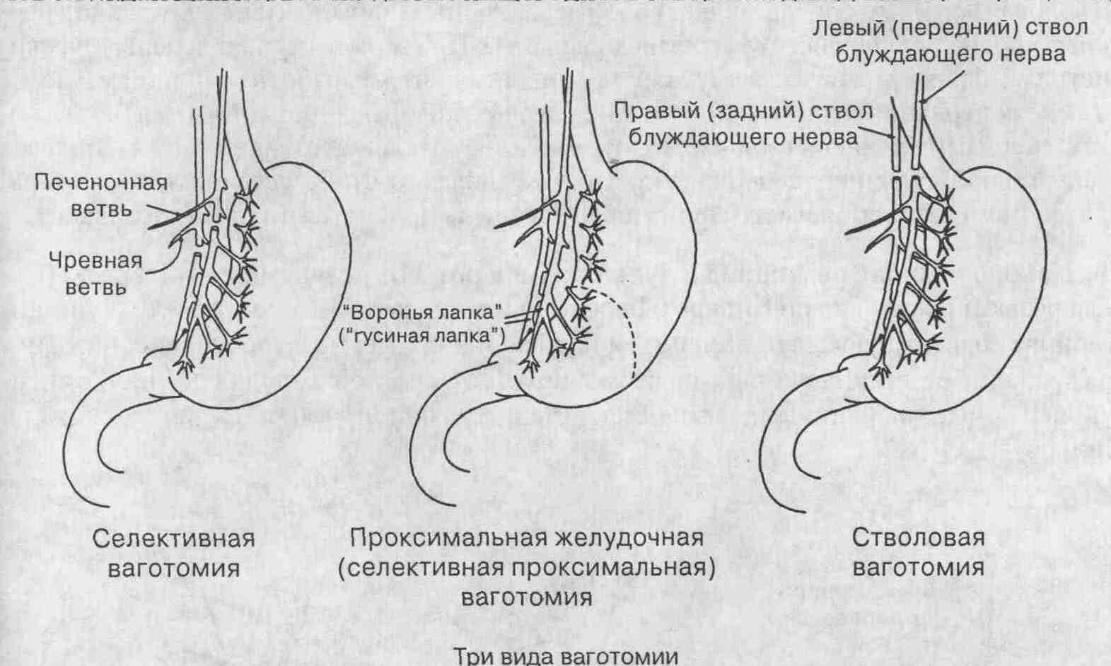 Операция лахея схема